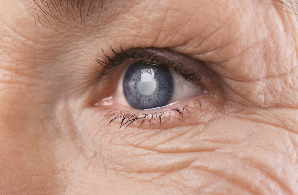 A close-up of an eye with glaucoma